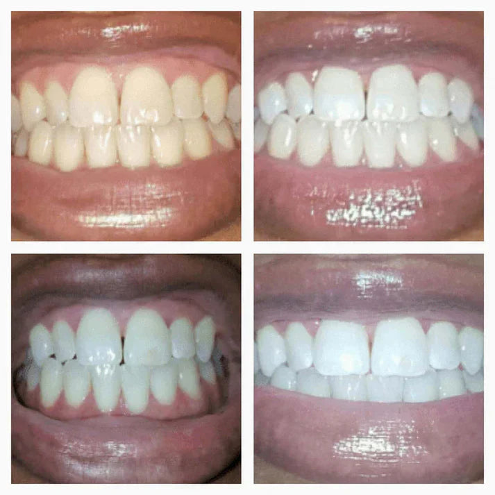 𝑶𝒇𝒇𝒊𝒄𝒊𝒂𝒍 𝑺𝒕𝒐𝒓𝒆 |𝐑𝐄𝐊𝐔𝐋𝐎™ 👩‍⚕️Teeth Whitening Pen