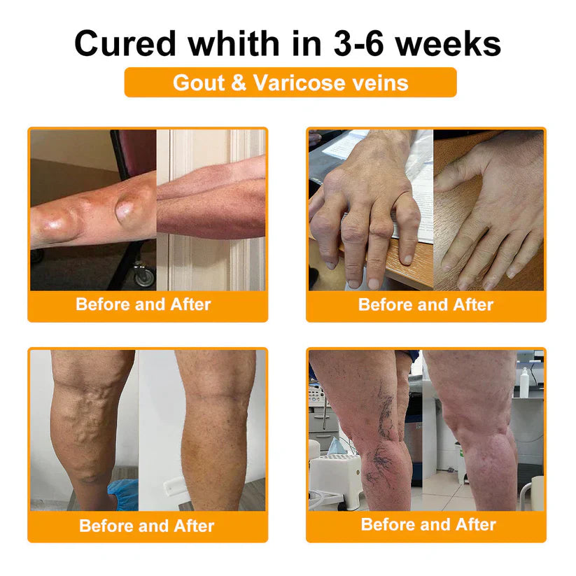 🥰𝑶𝒇𝒇𝒊𝒄𝒊𝒂𝒍 𝑺𝒕𝒐𝒓𝒆  | Rolimey® Bee Venom Pain Relief Bone Healing Cream 👨‍⚕️(Reduction of joint swelling, pain, stiffness, redness, heat, muscle soreness and joint fatigue)