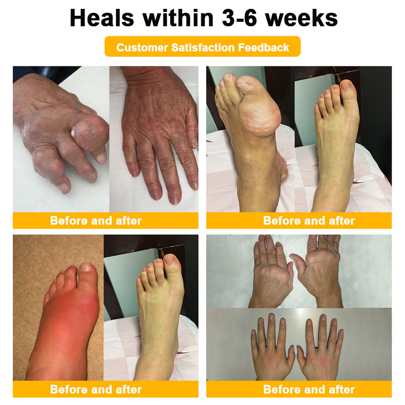 🥰𝑶𝒇𝒇𝒊𝒄𝒊𝒂𝒍 𝑺𝒕𝒐𝒓𝒆  | Rolimey® Bee Venom Pain Relief Bone Healing Cream 👨‍⚕️(Reduction of joint swelling, pain, stiffness, redness, heat, muscle soreness and joint fatigue)